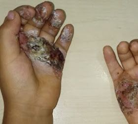 mão capa - Mãe queima as mãos do próprio filho no Maranhão e é presa - minuto barra