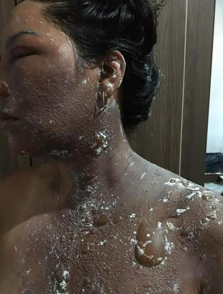 COVARDIA: No Maranhão, ex-vereador joga água quente no rosto da própria esposa